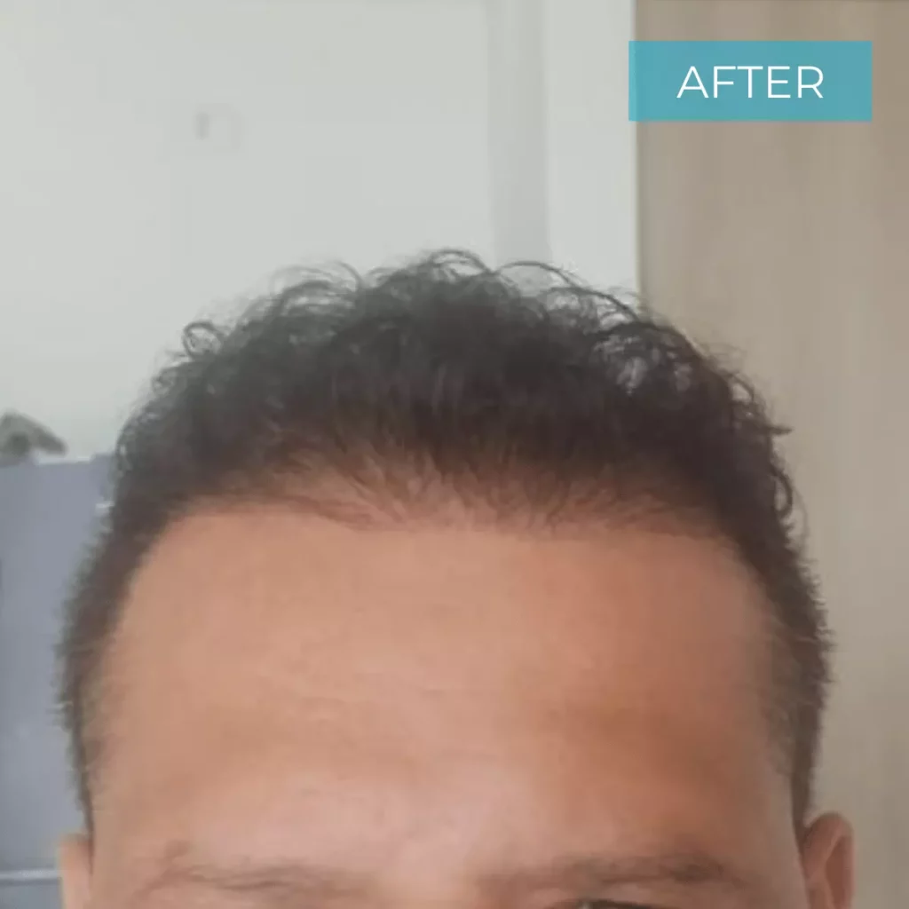 Hair Transplant Colombia BEFORE 11
