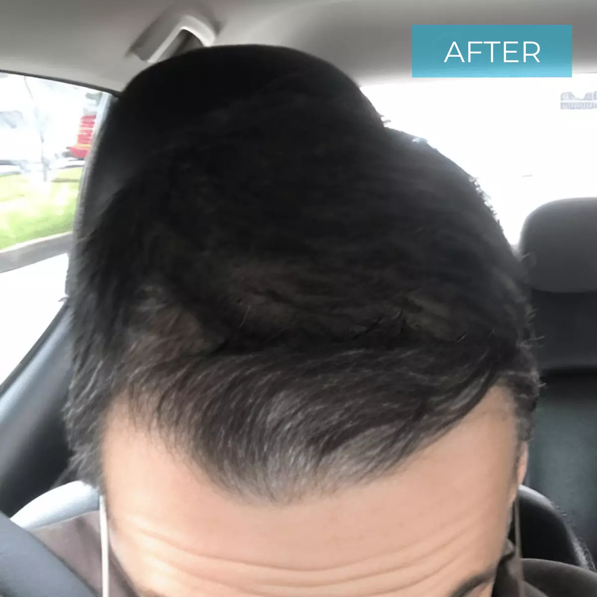 Hair Transplant Colombia BEFORE 21