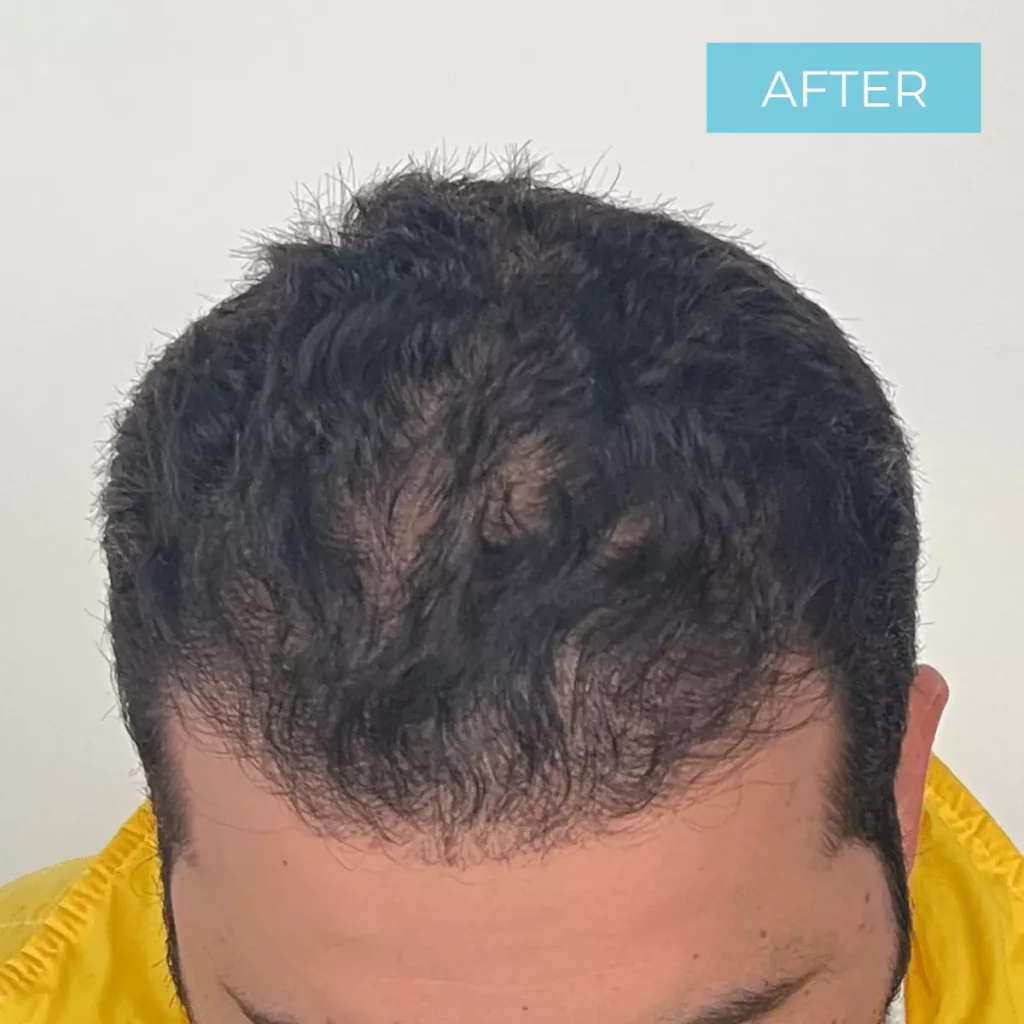Hair Transplant Colombia BEFORE 31
