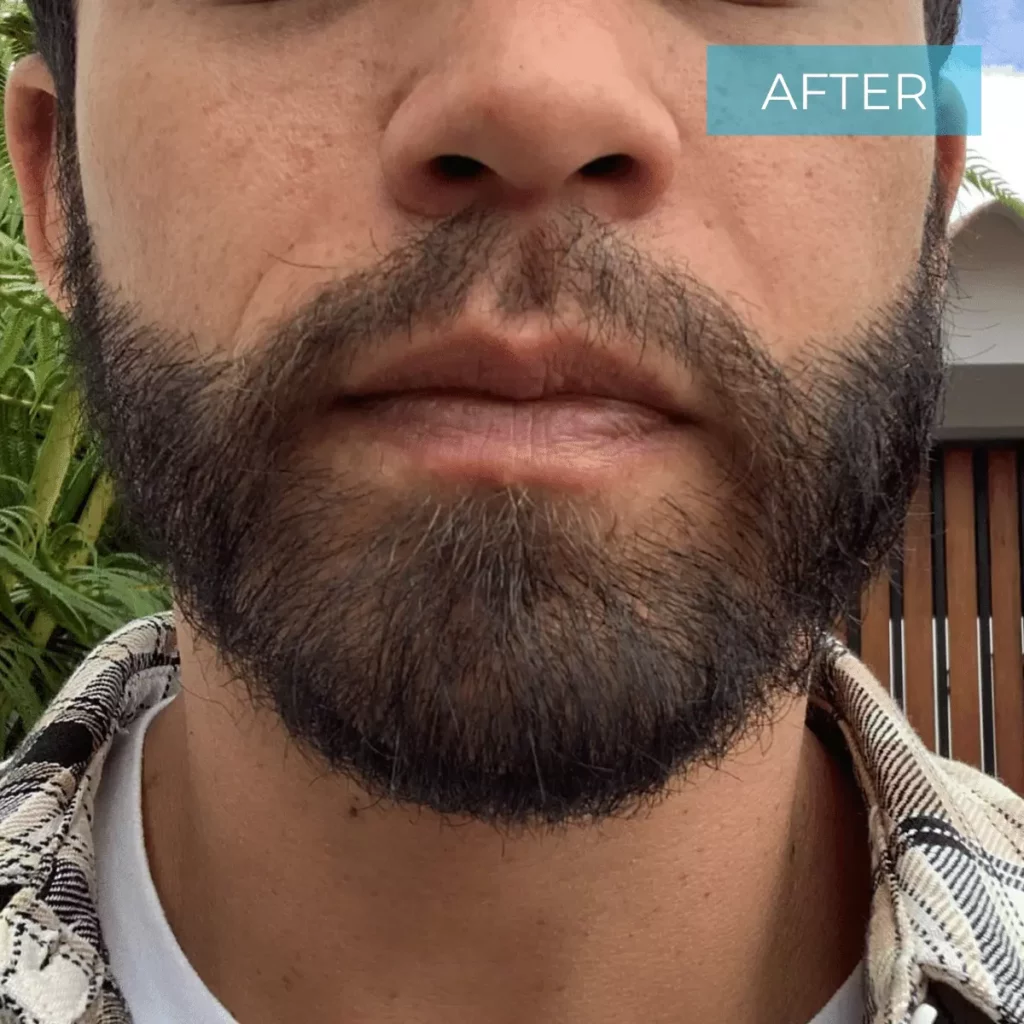 Hair Transplant Colombia BEFORE 41