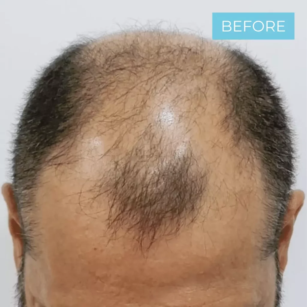 Hair Transplant Colombia BEFORE 11