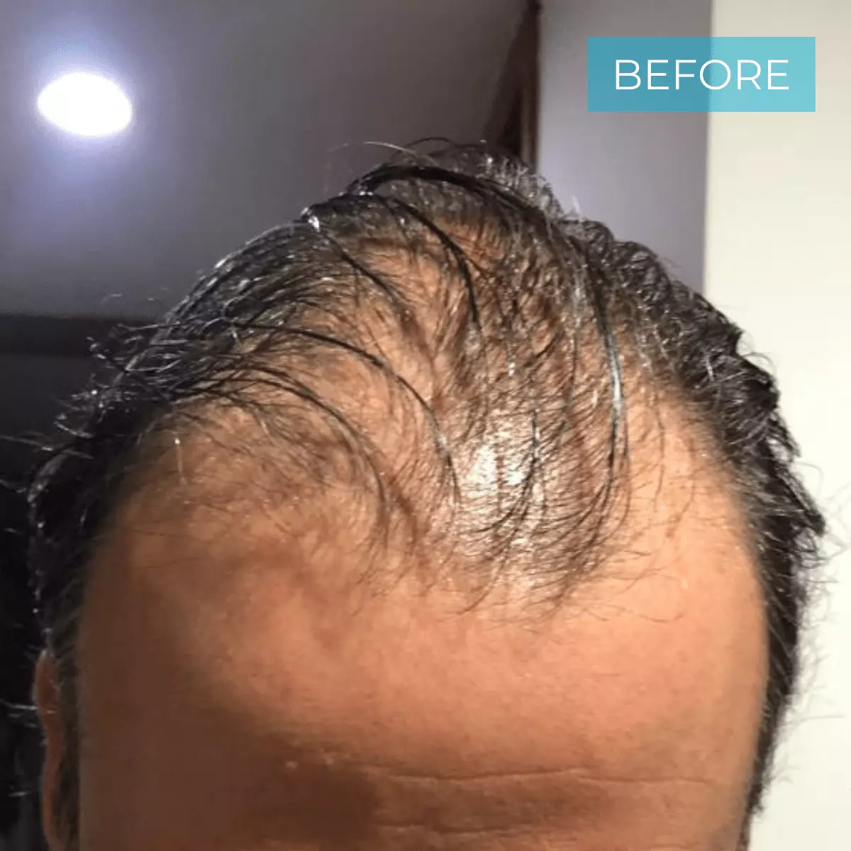 Hair Transplant Colombia BEFORE 21