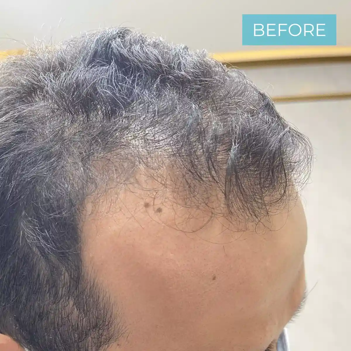 Hair Transplant Colombia BEFORE 31